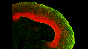 Brains in a Dish: Using Cerebral Organoids to Study Human Brain Development and Disease