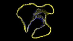 Drug Screening with Human Pancreatic Organoid Cultures